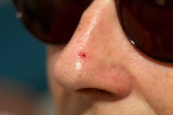 Oh no, an eruption - geriatric acne
Keywords: Adelaide Australia Marjorie South Zit